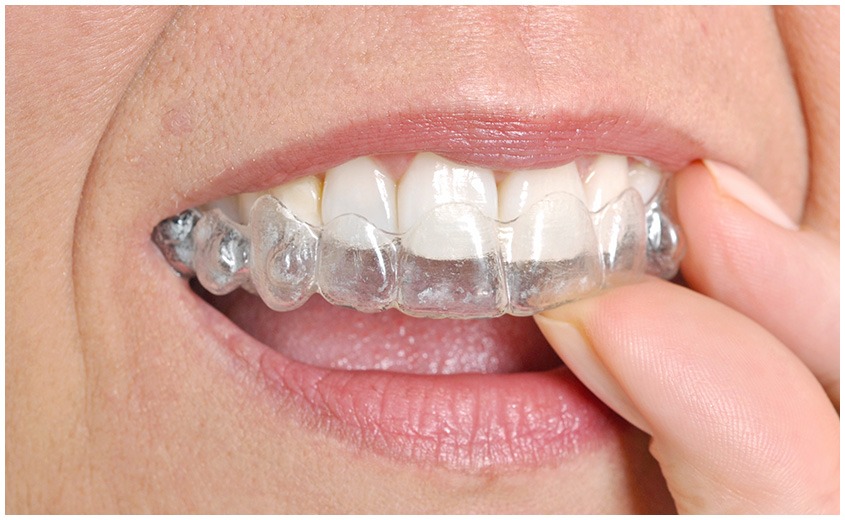 East York Clear Aligners | Dolphin Dental | East York Dentist