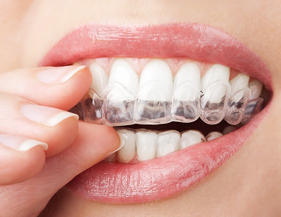 East York Clear Aligners | Dolphin Dental | East York Dentist