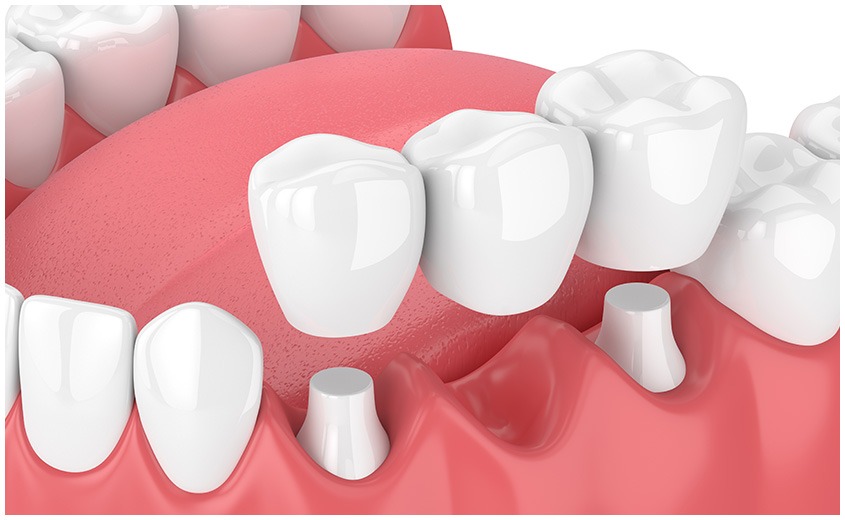 East York Dental Bridge | Dolphin Dental | East York Dentist
