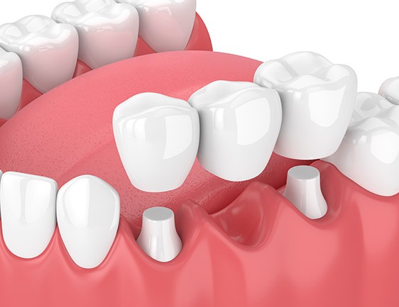 East York Dental Bridges | Dolphin Dental | East York Dentist