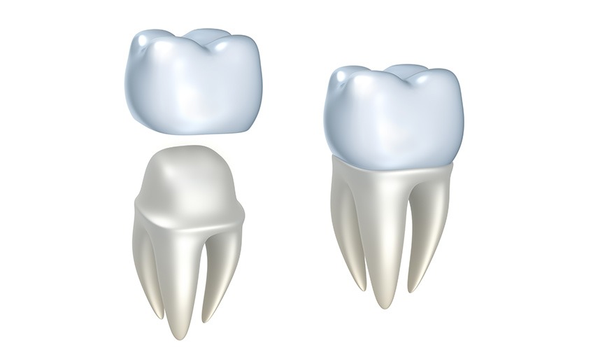 East York Dental Crowns | Dolphin Dental | East York Dentist