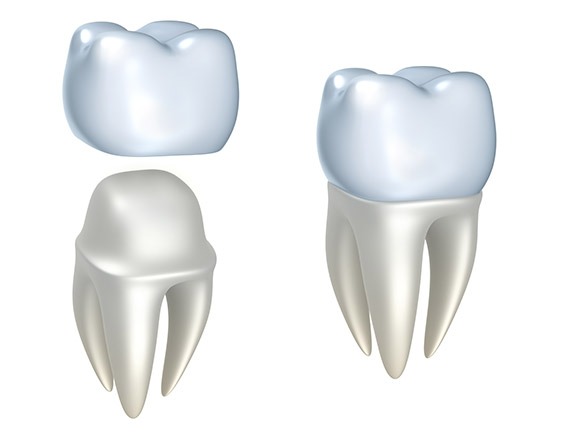 East York Dental Crowns | Dolphin Dental | East York Dentist