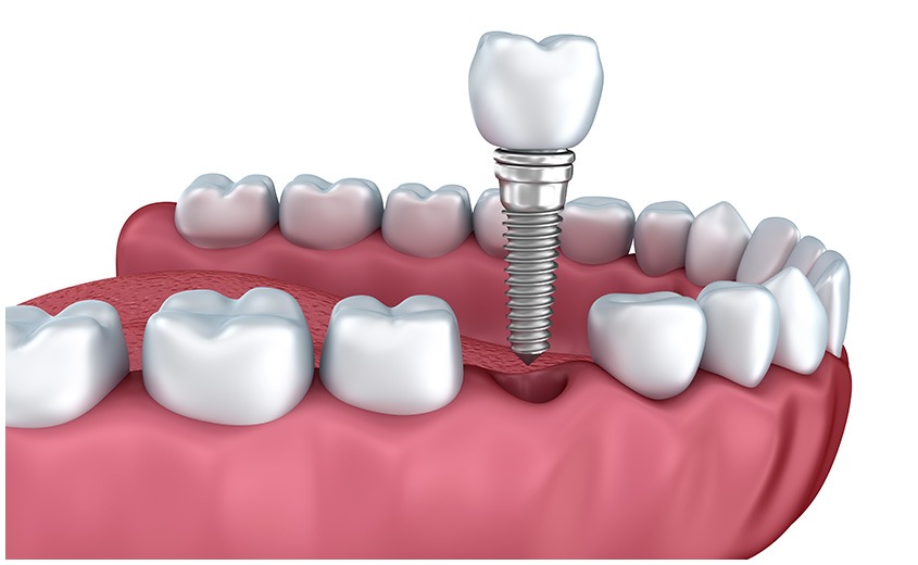 East York Dental Implants | Dolphin Dental | East York Dentist