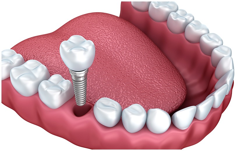 East York Dental Implants | Dolphin Dental | East York Dentist