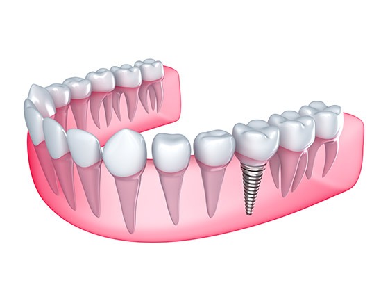 East York Dental Implants | Dolphin Dental | East York Dentist