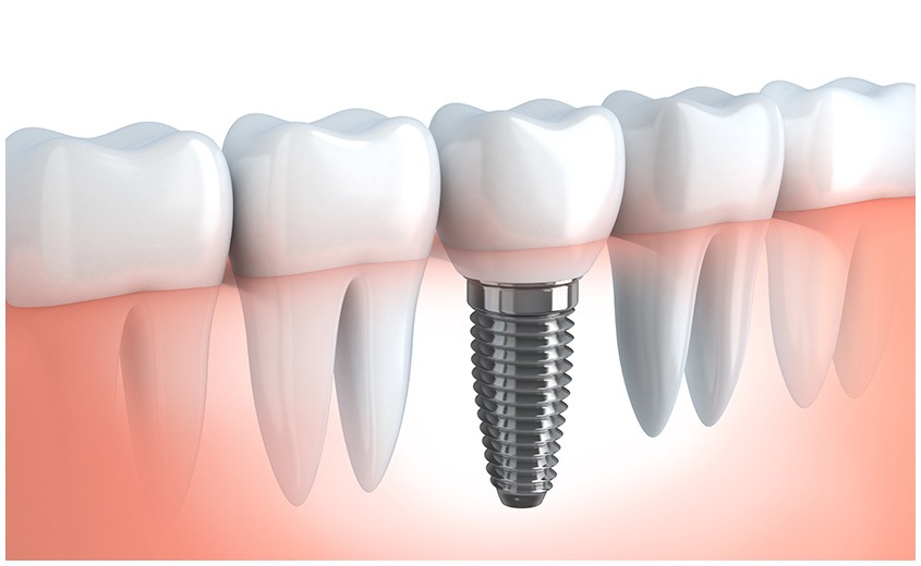 East York Dental Implants | Dolphin Dental | East York Dentist