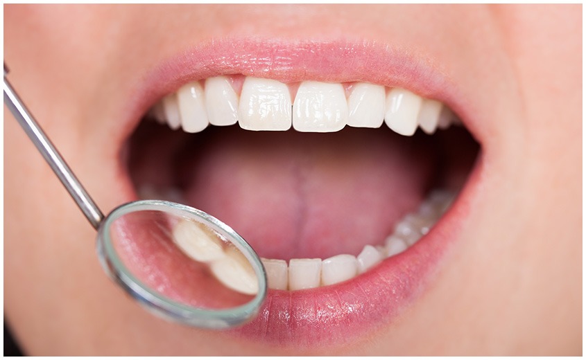 East York Hygiene & Teeth Cleaning | Dolphin Dental | East York Dentist