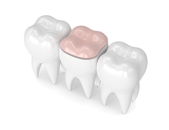 East York Porcelain Inlays and Onlays | Dolphin Dental | East York Dentist