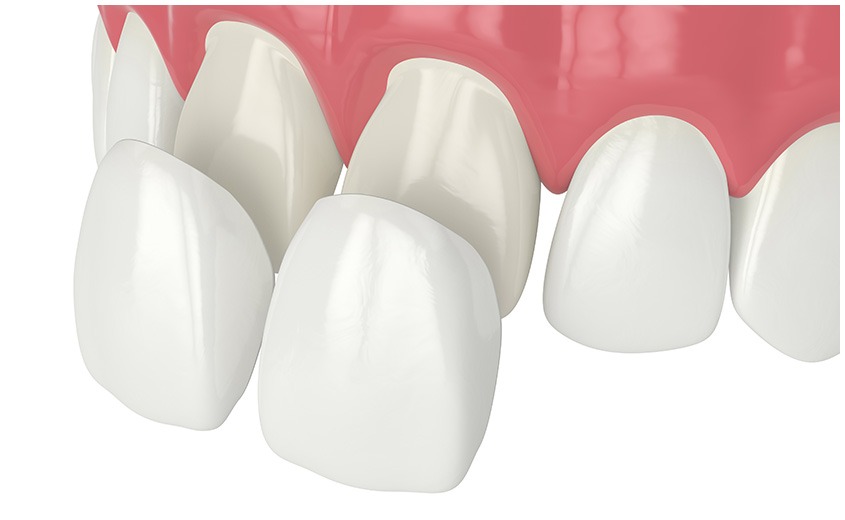 East York Porcelain Veneers | Dolphin Dental | East York Dentist