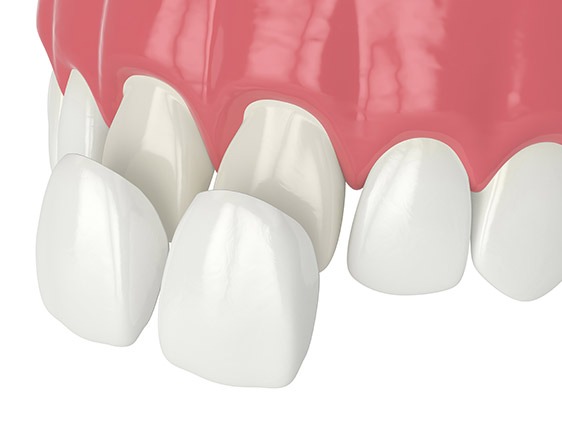 East York Porcelain Veneers | Dolphin Dental | East York Dentist