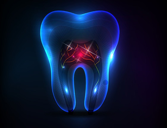 East York Root Canal Therapy | Dolphin Dental | East York Dentist