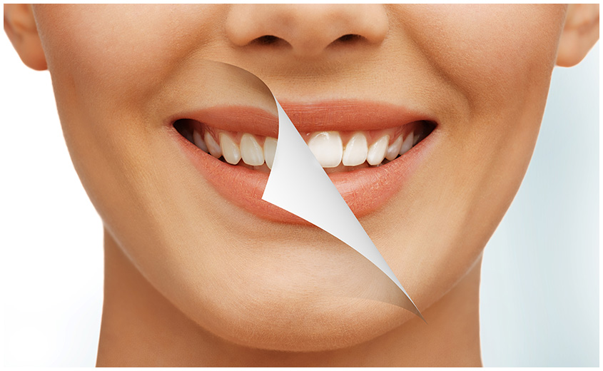 East York Teeth Whitening | Dolphin Dental | East York Dentist