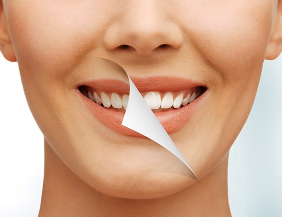 East York Teeth Whitening | Dolphin Dental | East York Dentist