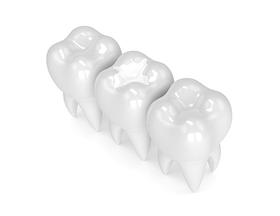 East York White Fillings | Dolphin Dental | East York Dentist